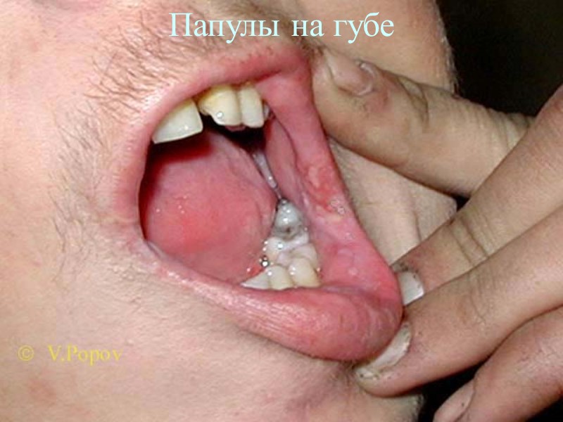 Папулы на губе